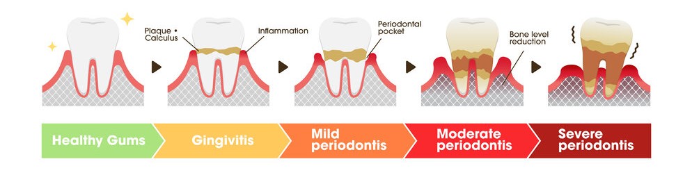 The Stages of Gum disease